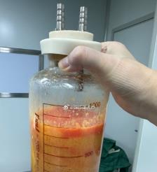 新沂水动力吸脂手术要做多久？